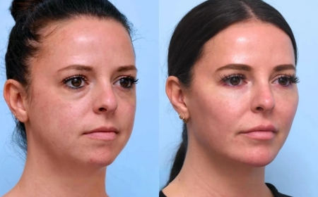 Best Plastic Surgeons in Dubai: Comparing Thread Lifts to Traditional Facelifts