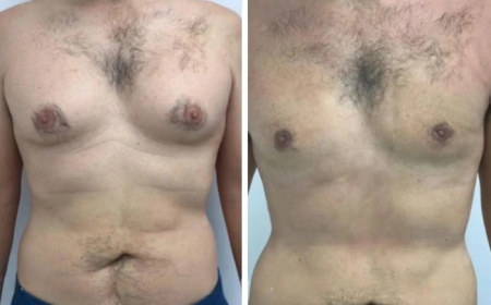 How the Best Gynecomastia Surgeons in Dubai Can Help You Achieve a Natural Look