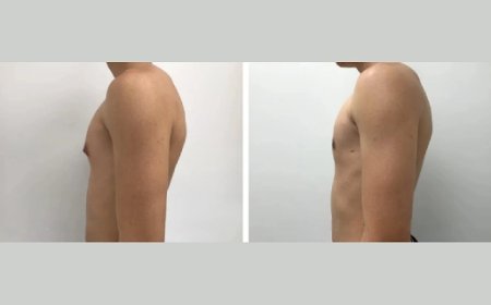 Why Dubai Is Home to Some of the Best Gynecomastia Surgeons in the World