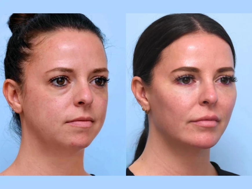 Best Plastic Surgeons in Dubai: Comparing Thread Lifts to Traditional Facelifts