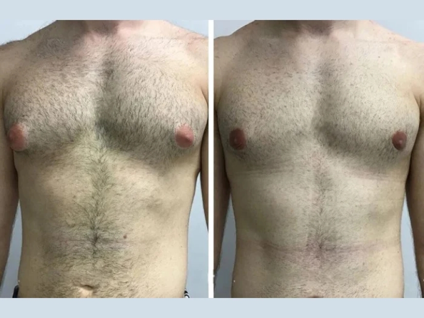 How to Prepare for Surgery with the Best Gynecomastia Surgeon in Dubai