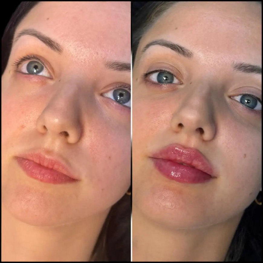 Why Fillers from the Best Plastic Surgeon in Dubai Are Worth the Investment