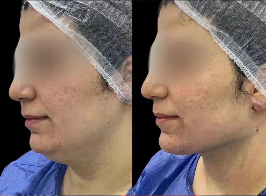 How Chin Fillers Treatment in Dubai Can Enhance Your Profile
