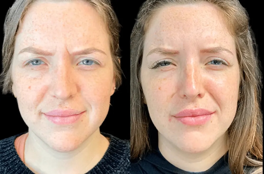 How Botox Treatment in Dubai Can Help You Achieve a Youthful Look