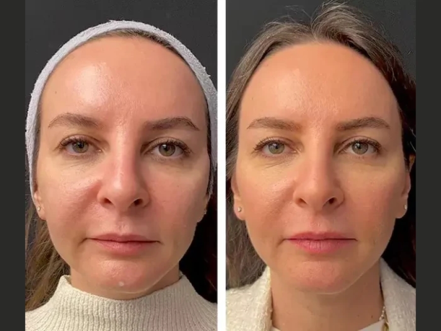 How the Best Doctors in Dubai Perform Safe and Effective Mesotherapy