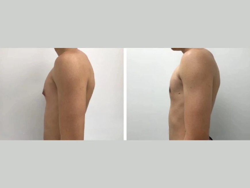 Why I Chose Dubai for My Gynecomastia Treatment