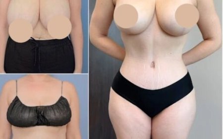 Choosing the Best Tummy Tuck Surgeon in Dubai for Your Body Transformation