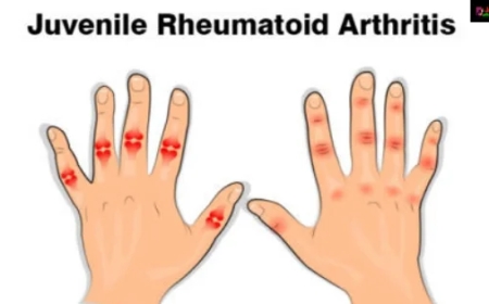 Beyond Basic Pain: How Brufen 400 mg Tackles Inflammation