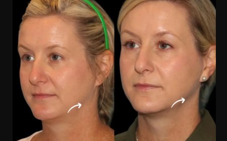 What Are Sculptra Fillers in Dubai and Why Are They Trending?