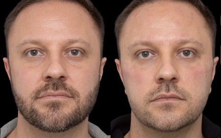 The Ideal Age to Start Considering Under Eye Fillers in Dubai