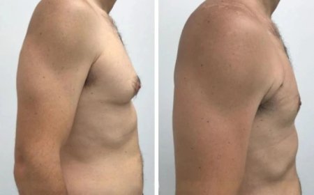 The Best Gynecomastia Surgeons in dubai: A Comprehensive Review