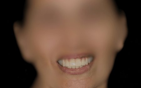 Implantes de Carga Inmediata en Barcelona Sonrisa Nueva en un Día