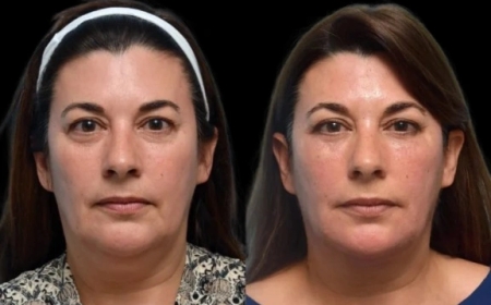 Dark Circles Treatment in Dubai: The Best Under-Eye Creams and Serums Available