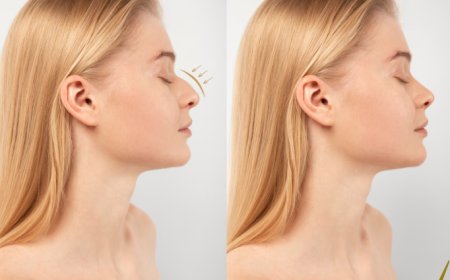 Refine Your Nose with Precision and Discreet Healing with Closed Rhinoplasty