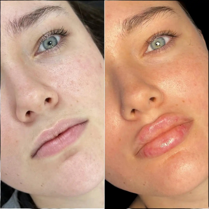 Best Doctors in dubai for Fillers: Understanding Filler Composition