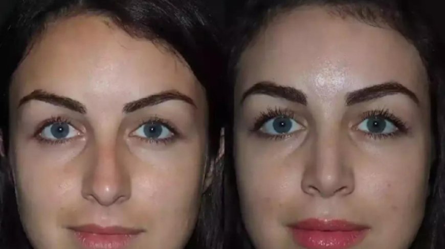 Nose Surgery in Dubai for Breathing and Beauty