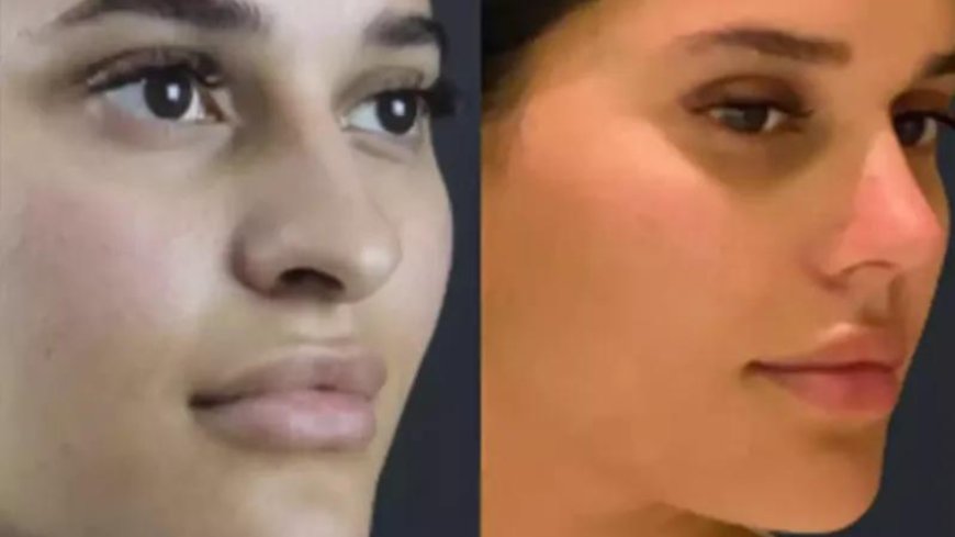 Is Nose Deviated Septum Surgery in Dubai Safe and Effective?
