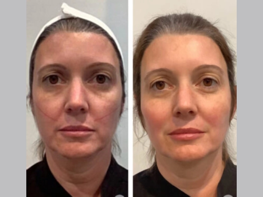 Best Aesthetic Clinics in Dubai for Thread Lift: Client Testimonials and Results
