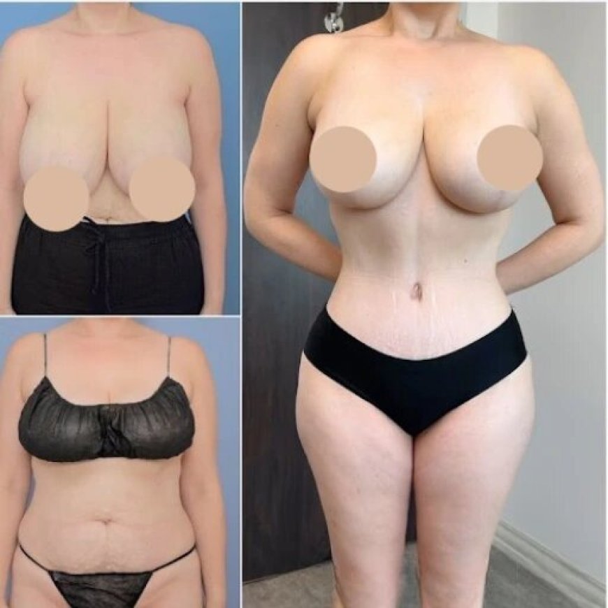 Choosing the Best Tummy Tuck Surgeon in Dubai for Your Body Transformation