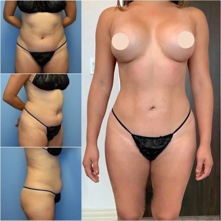 Discover the Best Body Contouring Surgeon in Dubai for Your Perfect Physique