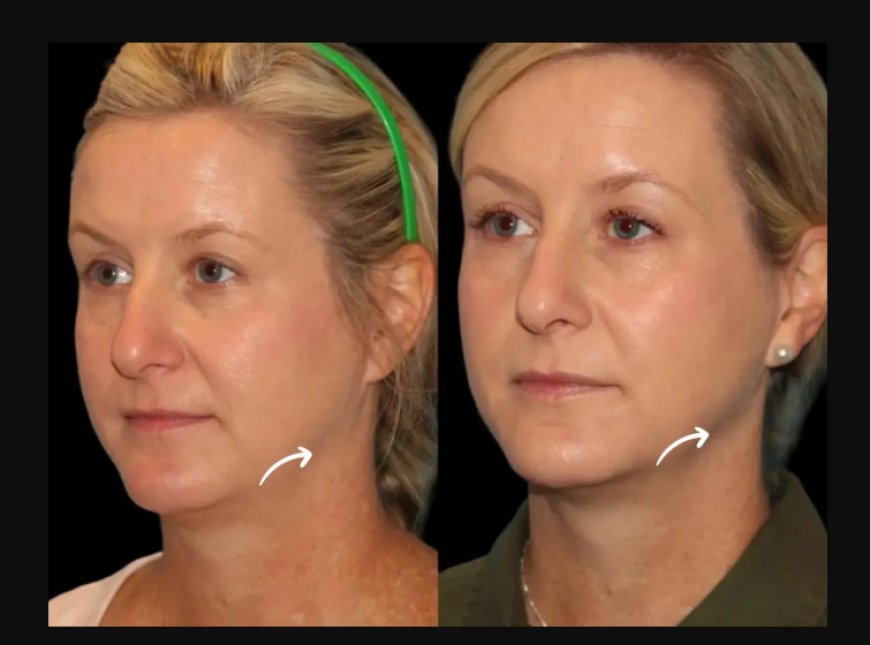 What Are Sculptra Fillers in Dubai and Why Are They Trending?