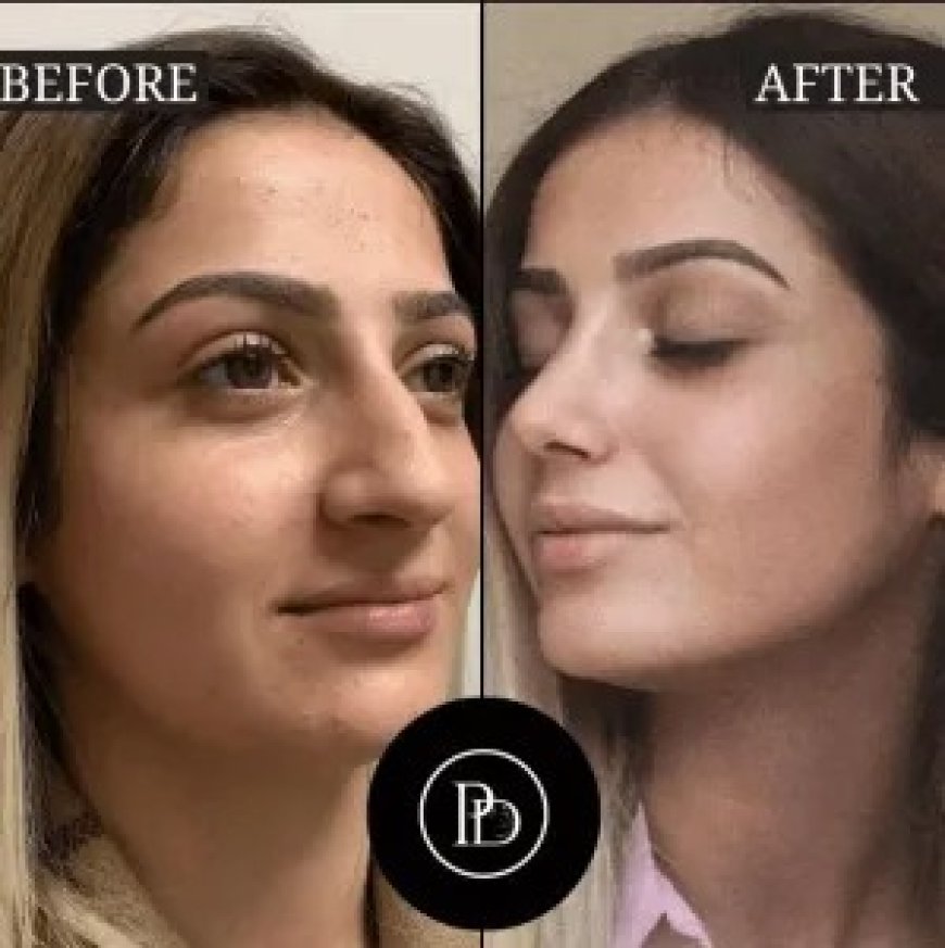 Step-by-Step Breakdown of PRP Treatment in Dubai