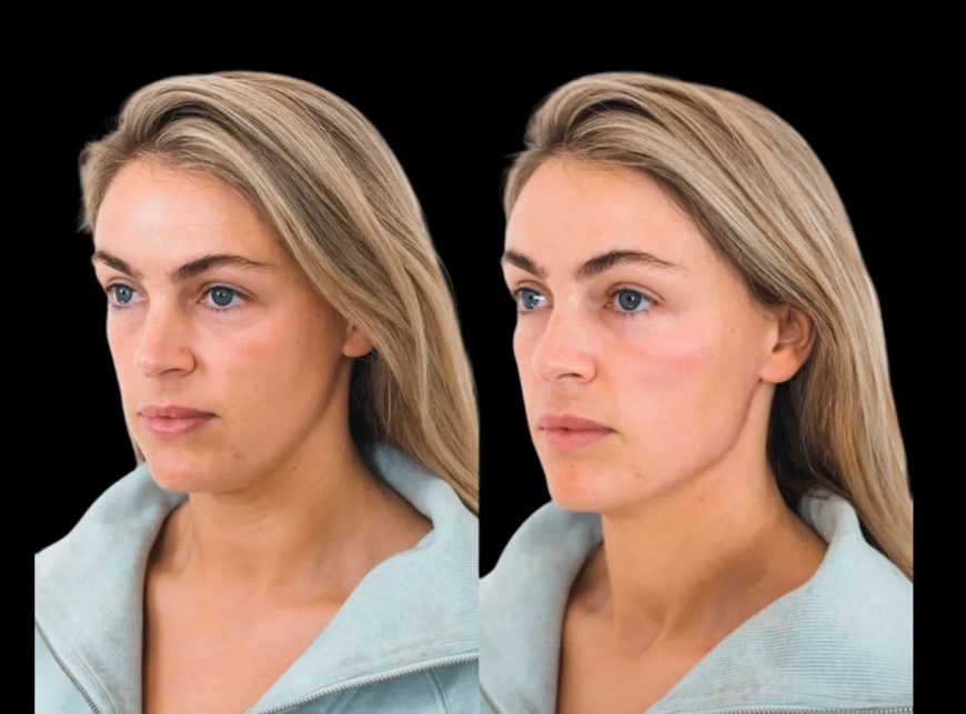 Cheek Fillers in Dubai: What’s the Recovery Process Like?