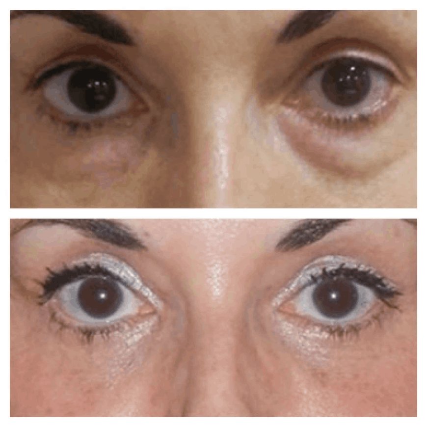 Best Doctors in Dubai Share Their Favorite Products to Use After Eye Bag Removal