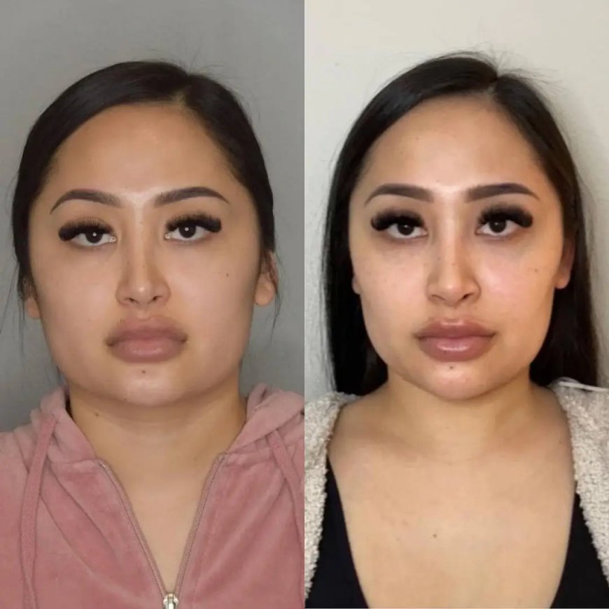 Buccal Fat Removal in Dubai: Why Patients Choose the Best Doctors in Dubai