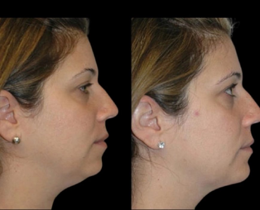 Why Timing Matters for Double Chin Removal: Best Doctors in Dubai