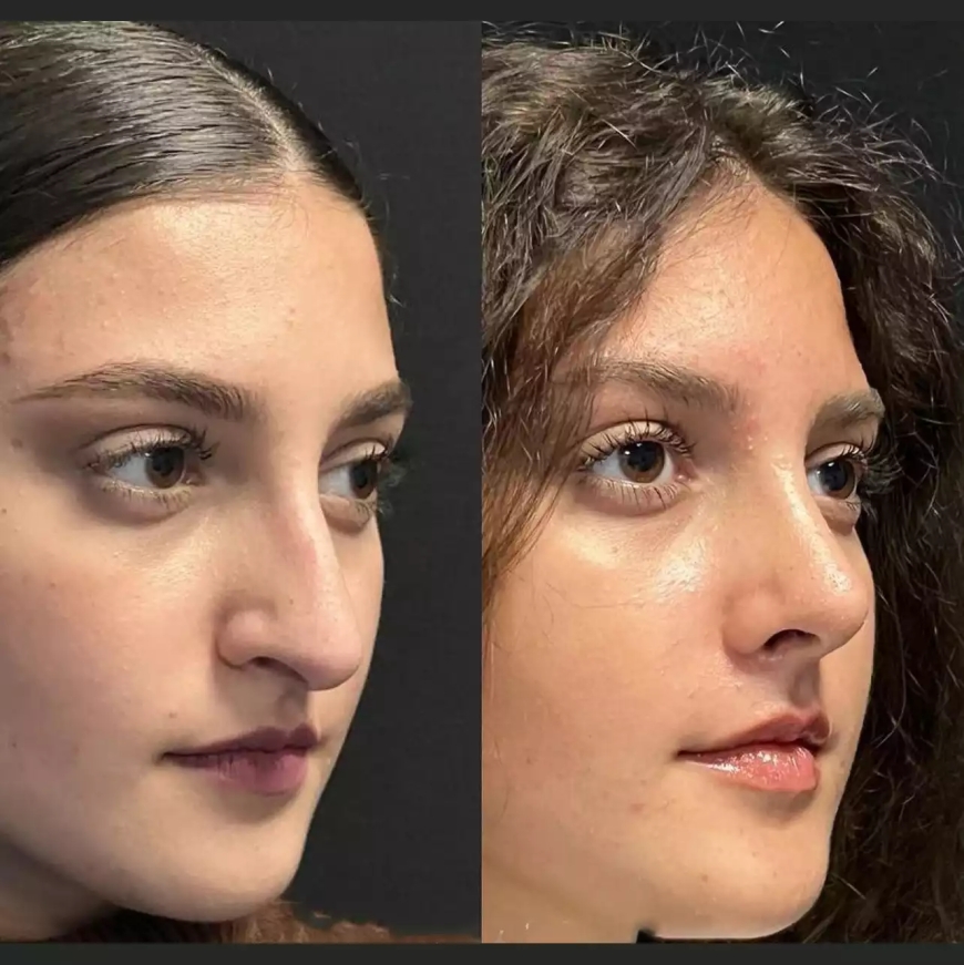 Septoplasty in Dubai: When Should You Consider It?