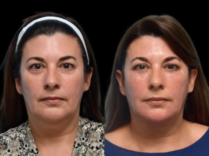 Dark Circles Treatment in Dubai: The Best Under-Eye Creams and Serums Available