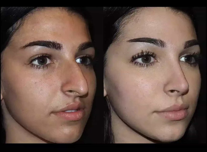 Best Septoplasty Surgeon in Dubai: Modern & Precise